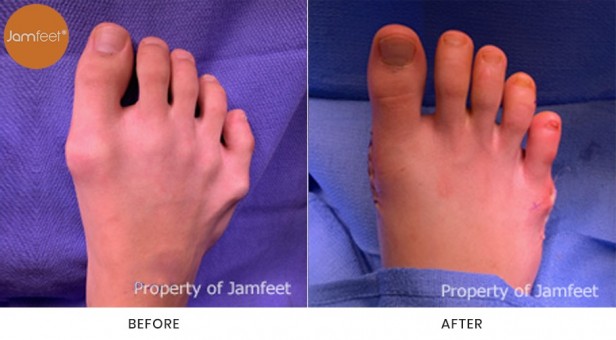 Bunion Surgery