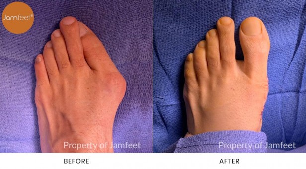 Bunion Surgery