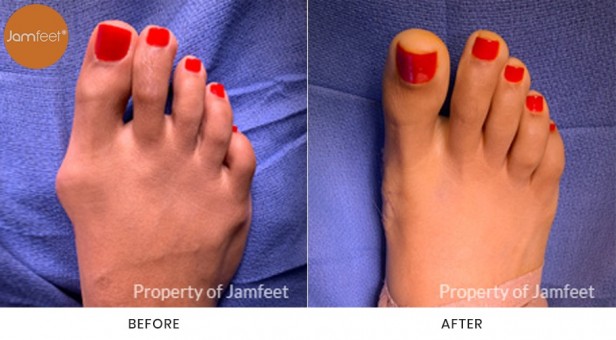 Bunion Surgery