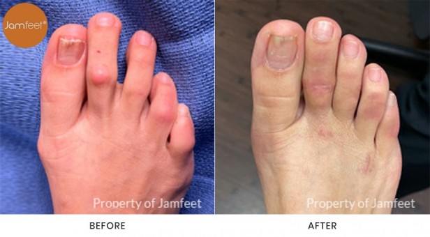 Bunion Surgery