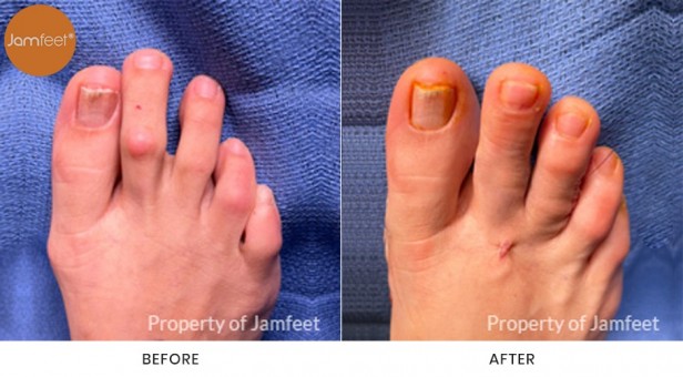Bunion Surgery