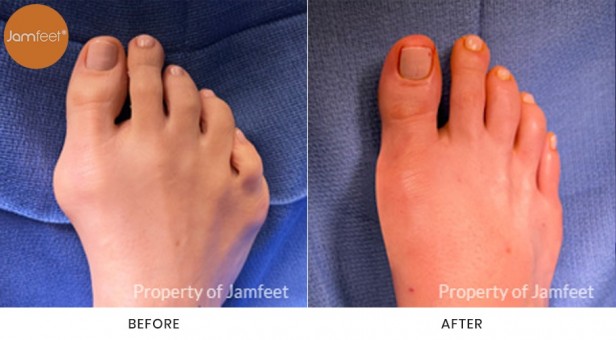 Bunion Surgery