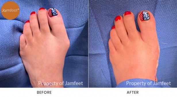 Bunion Surgery