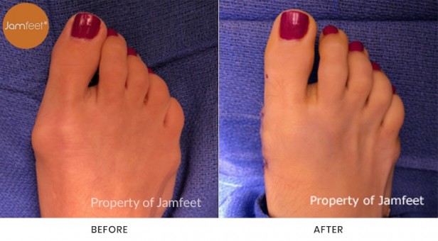 Bunion Surgery