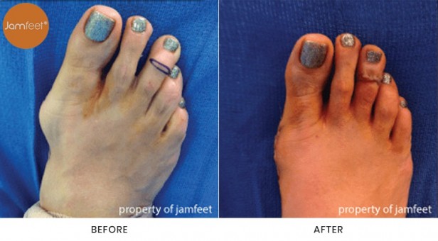 Bunion Surgery