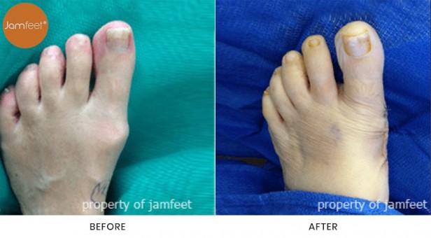Bunion Surgery