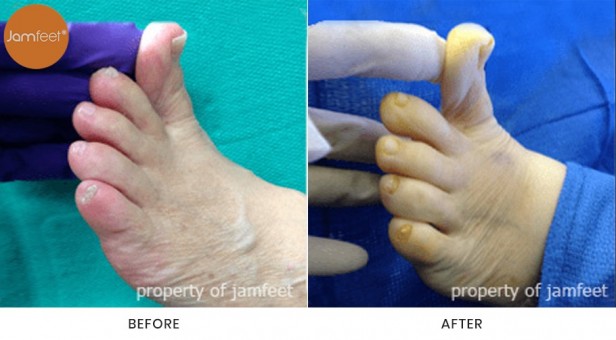 Bunion Surgery