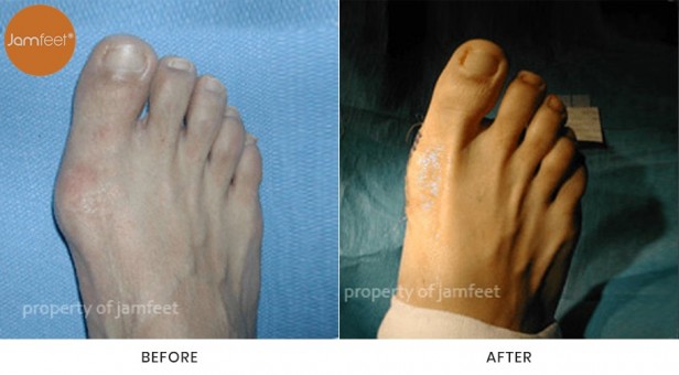 Bunion Surgery