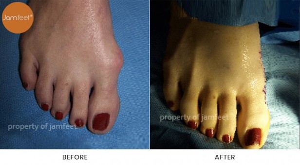 Bunion Surgery