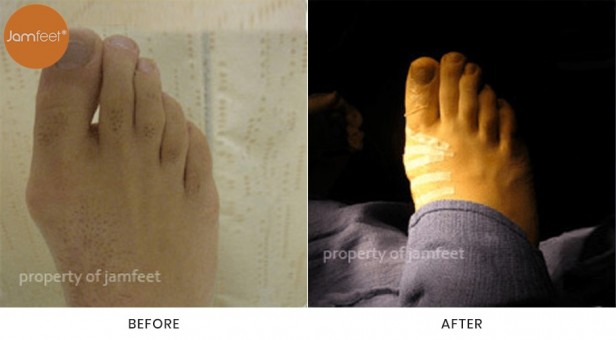 Bunion Surgery