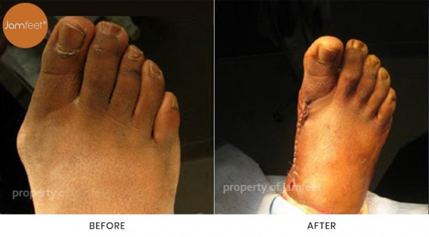 Bunion Surgery