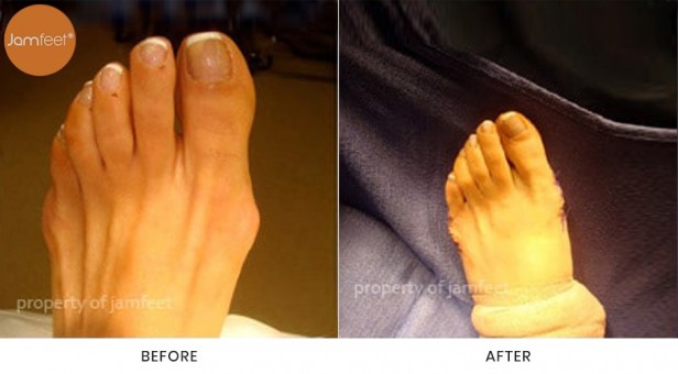 Bunion Surgery