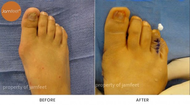 Bunion Surgery