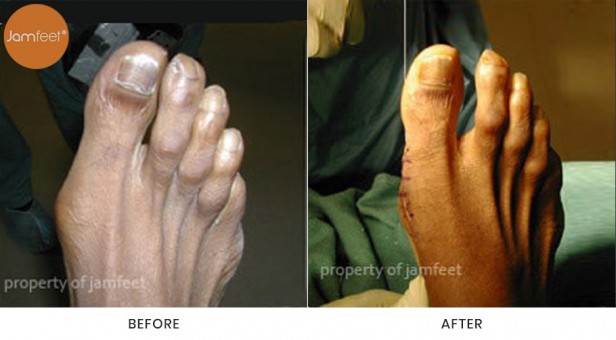 Bunion Surgery