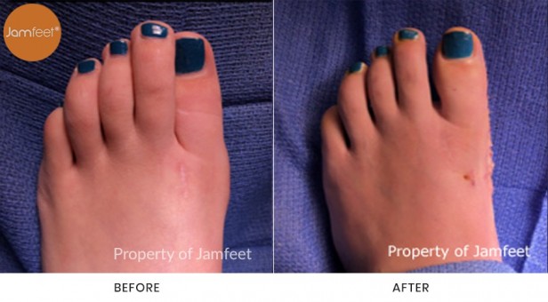 Bunion Surgery