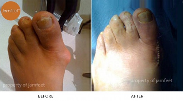 Bunion Surgery