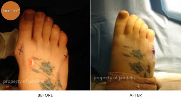 Bunion Surgery