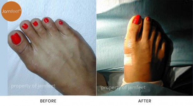 Bunion Surgery
