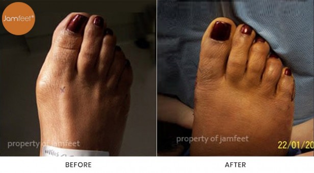 Bunion Surgery