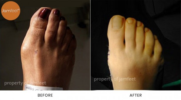 Bunion Surgery