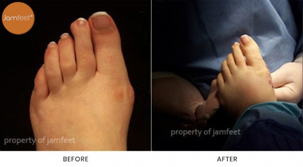 Bunion Surgery