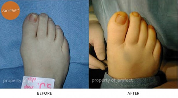 Bunion Surgery