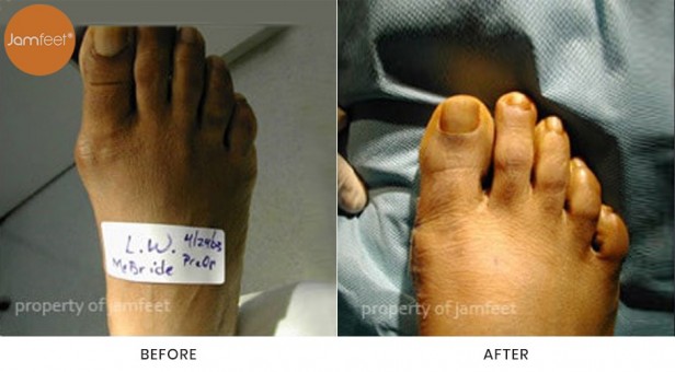 Bunion Surgery