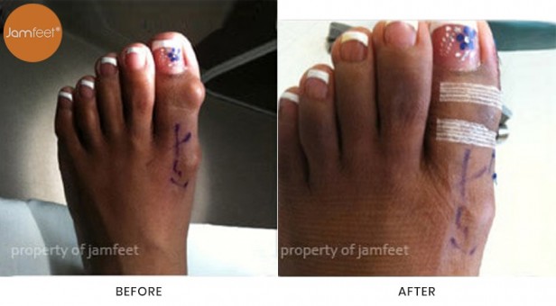 Bunion Surgery