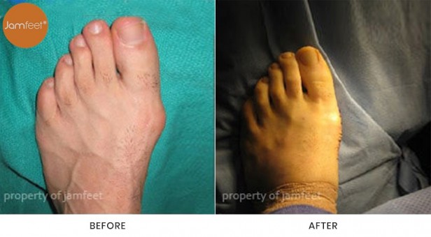 Bunion Surgery