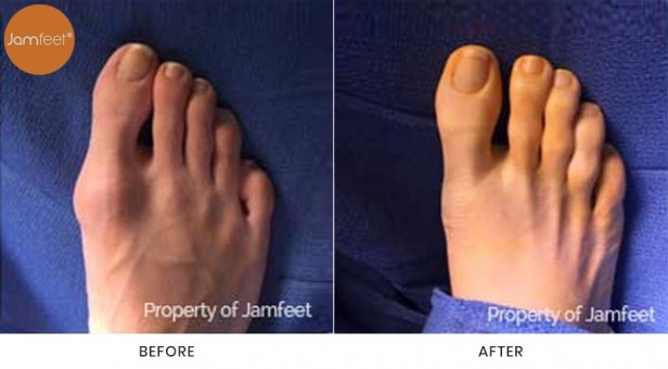 Bunion Surgery