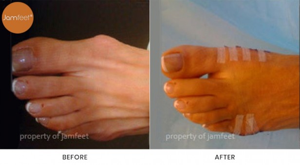 Bunion Surgery