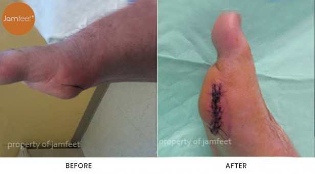 Bunion Surgery