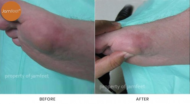 Bunion Surgery