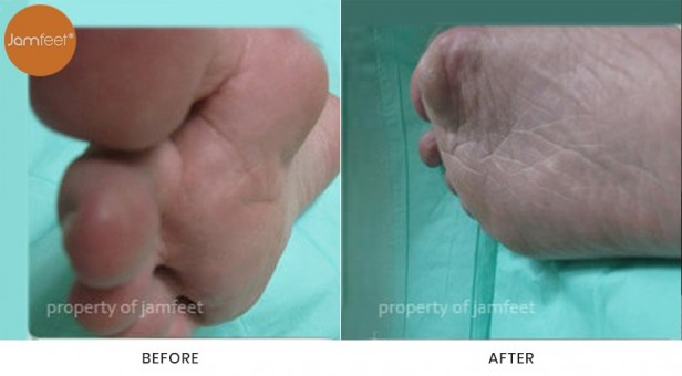 Bunion Surgery