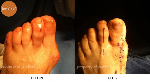 Bunion Surgery