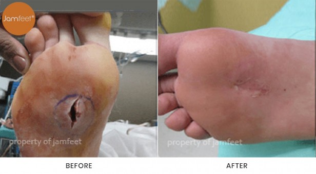 Bunion Surgery