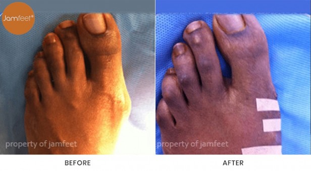 Bunion Surgery