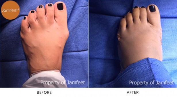 Bunion Surgery