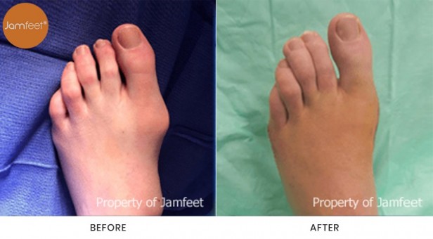 Bunion Surgery