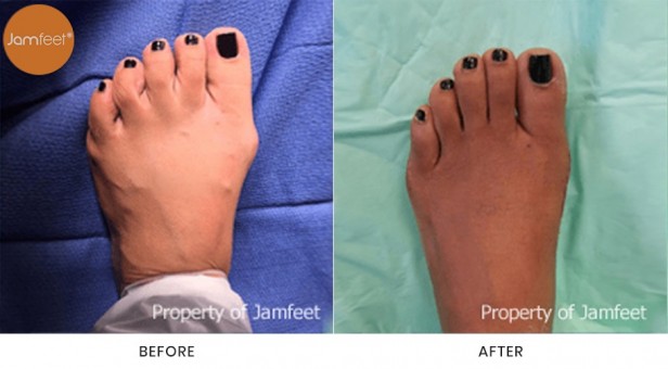 Bunion Surgery