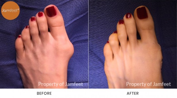 Bunion Surgery