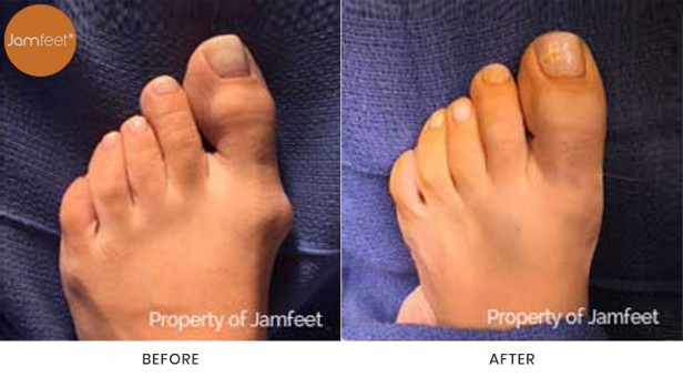 Bunion Surgery