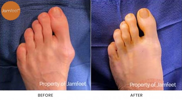 Bunion Surgery