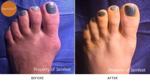 Bunion Surgery