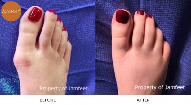 Bunion Surgery