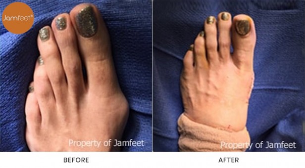 Bunion Surgery