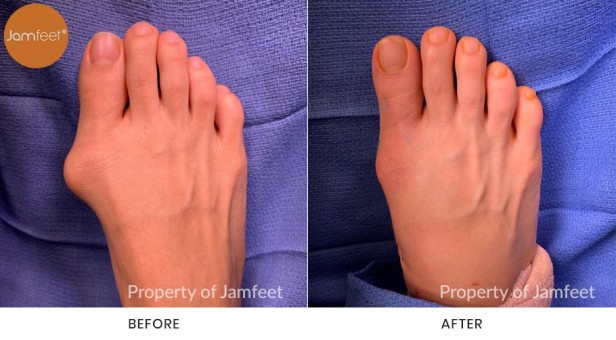 Bunion Surgery