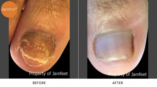 Toenail
