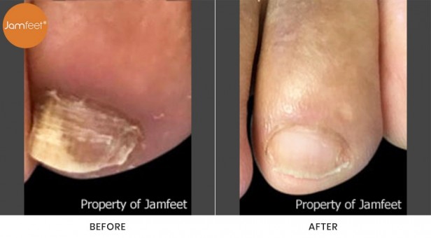 Toenail