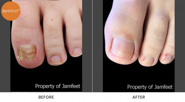 Toenail